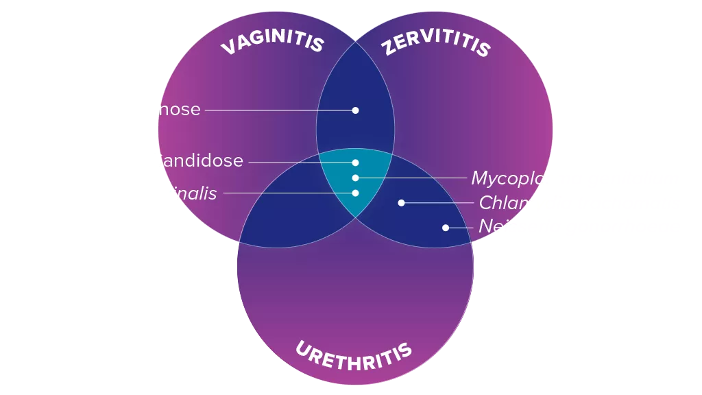 Abbildung der Symptome von Vaginitis, Zervizitis, Urethritis