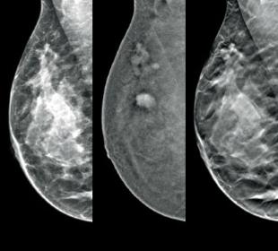 Hologic I-View™ Kontrastverstärkte Bildgebung